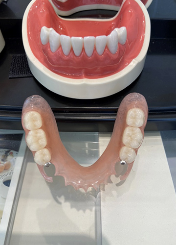 新しい入れ歯
