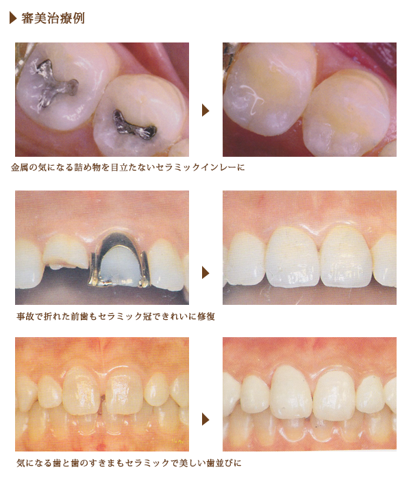 審美歯科治療例