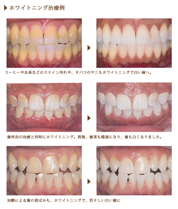 ホワイトニング治療例