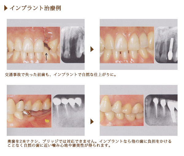 インプラント治療例