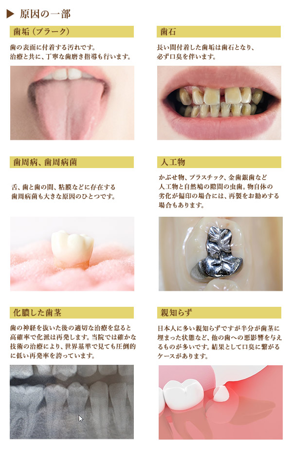 口臭の原因の一部